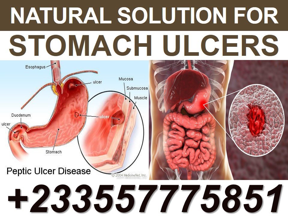 Natural Treatment For Stomach Ulcer