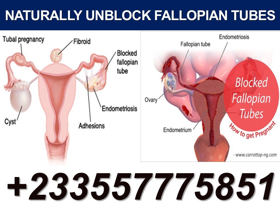 Fallopian Tubes Blockage Treatment 