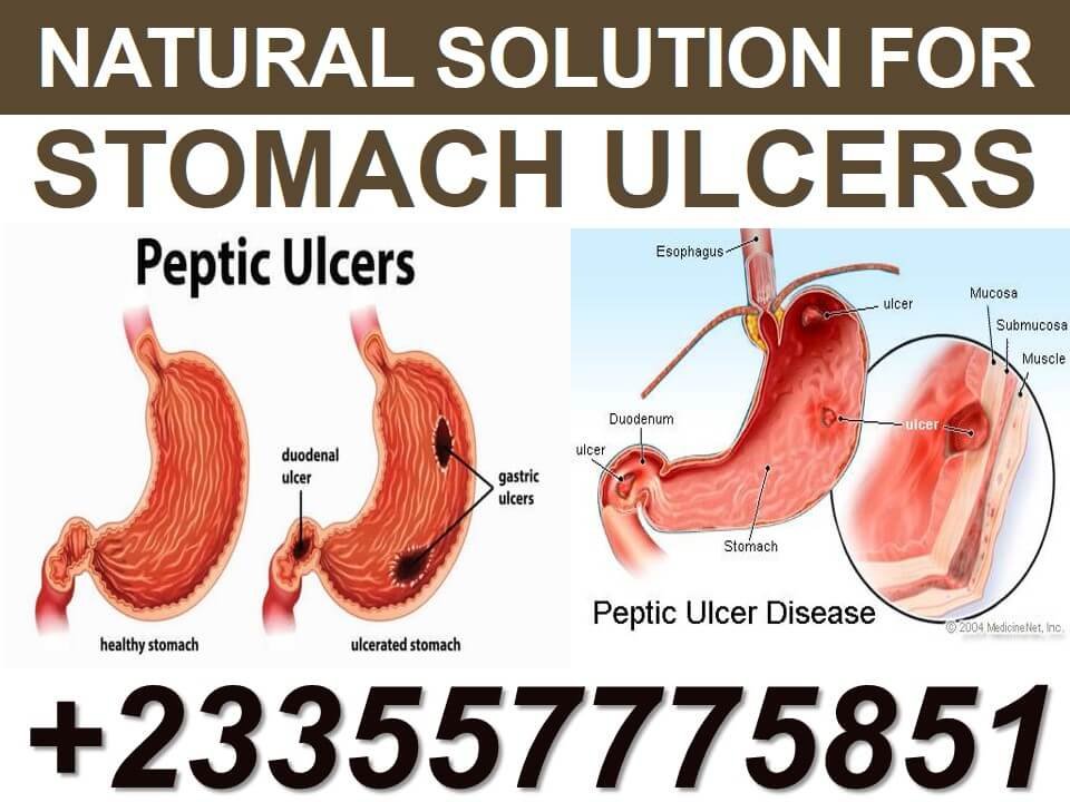 Forever Products for Stomach Ulcer