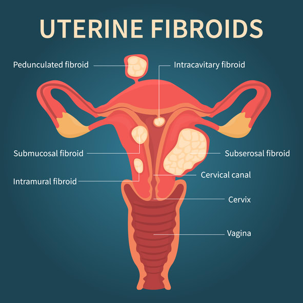 FIBROFIT - Tubal Blockage Fibroid Ovarian Cyst Candidiasis